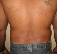 back lipo - before
