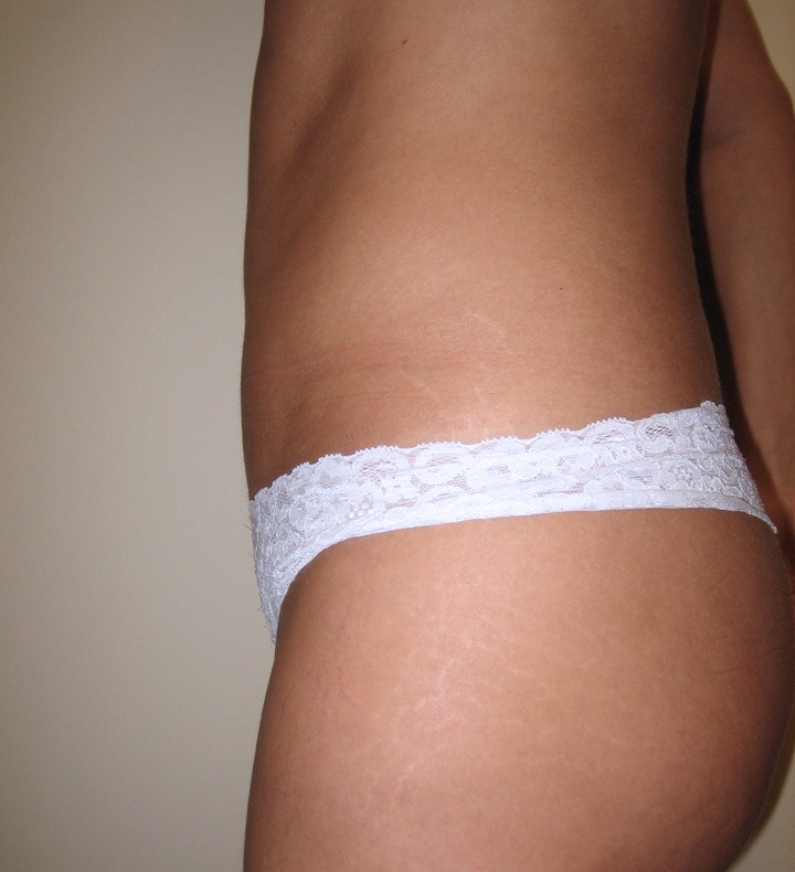 smart lipo candidate - after pictur