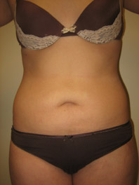 Smartlipo Before & After
