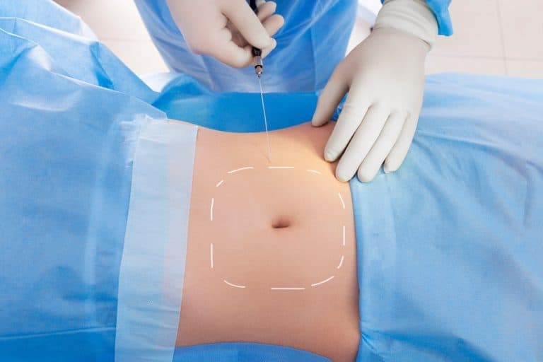 Micro Liposuction: Benefits and Risks Explained