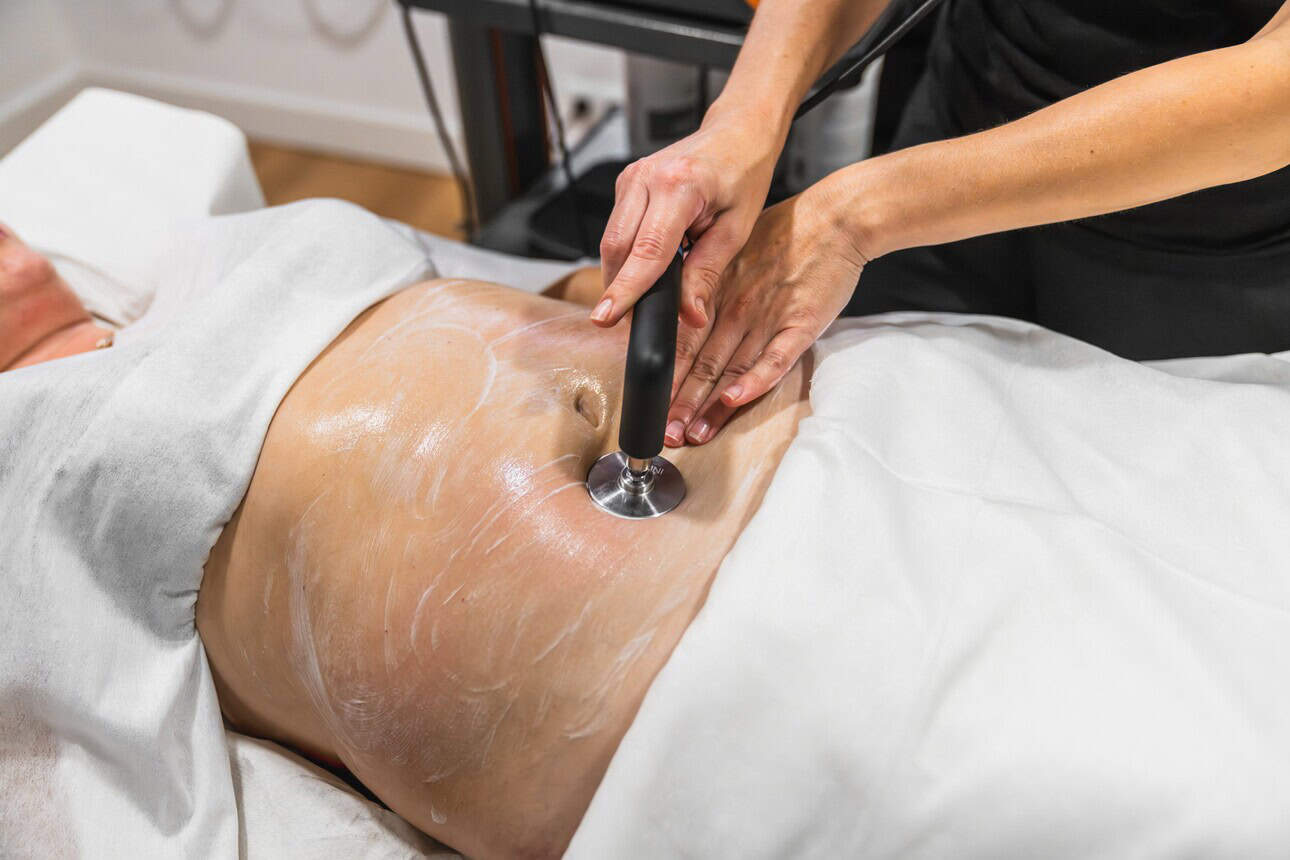 Liposuction procedure at New York Liposuction Center for body contouring and fat reduction.