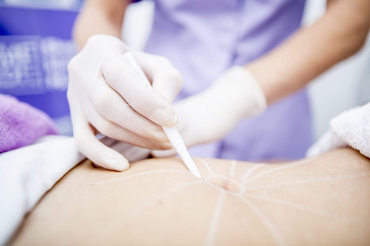 Smartlipo vs Traditional Liposuction