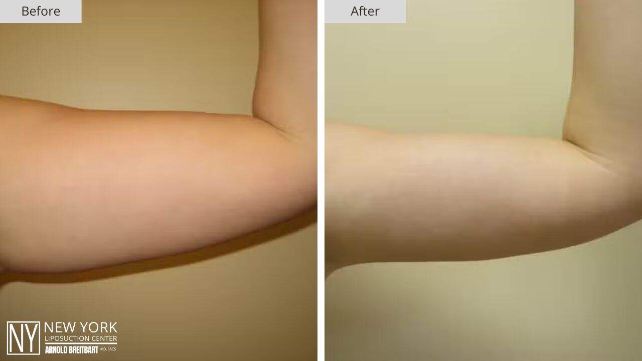 New York Arm Liposuction Before and After Front Patient 1 Left