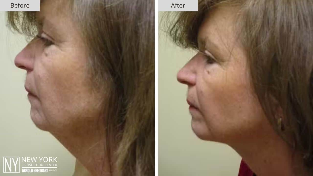 New York Chin Liposuction Before and After Face Patient 1 (2)