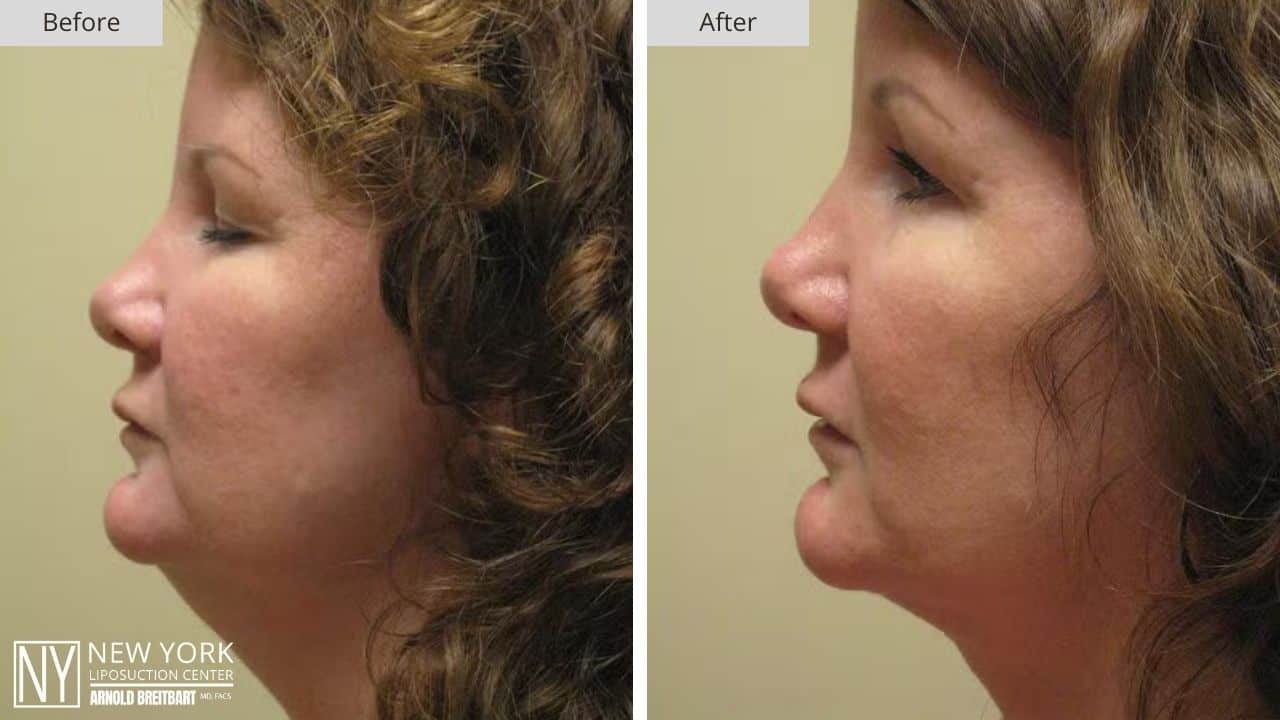 New York Chin Liposuction Before and After Patient 5