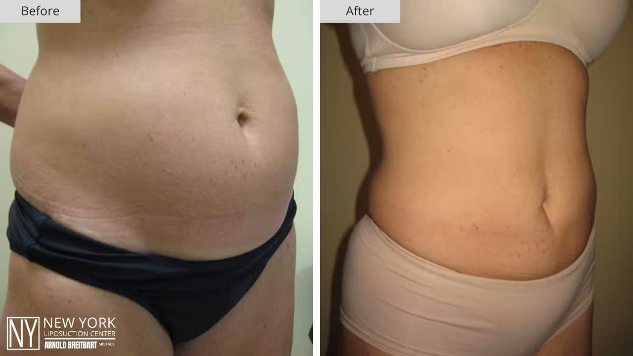 New York Love Handles Liposuction Before and After Side Patient 3