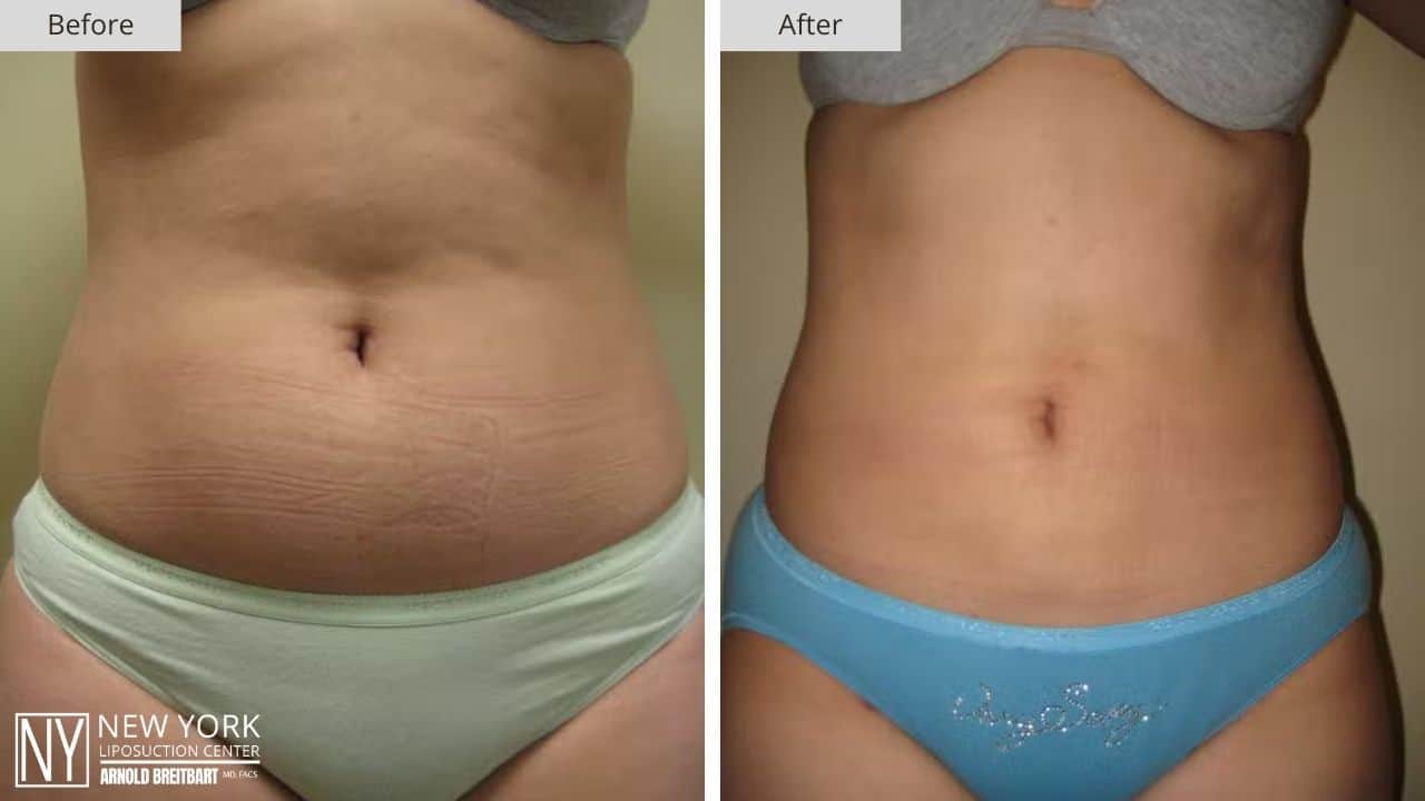 New York Stomach Liposuction Before and After Front Patient 2