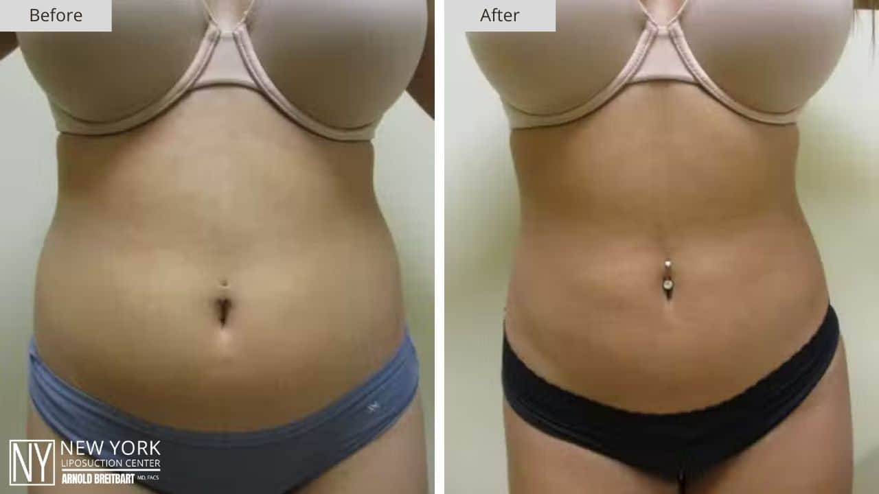 New York Stomach Liposuction Before and After Front Patient 4