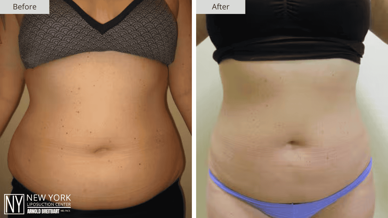 New York Stomach Liposuction Before and After Patient