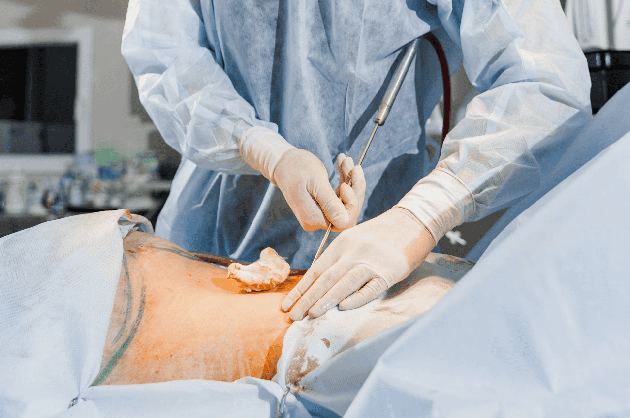 how to prevent complications after liposuction