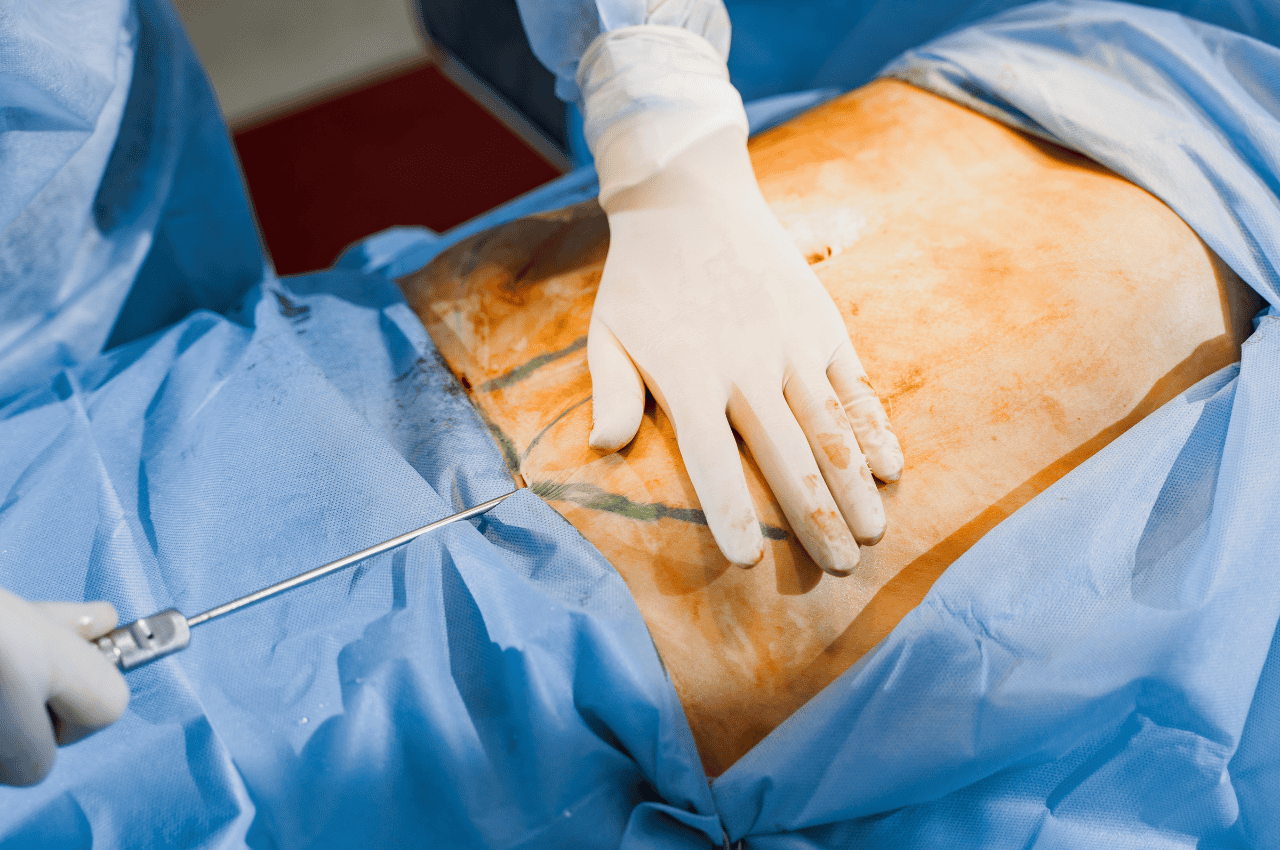 how does liposuction work