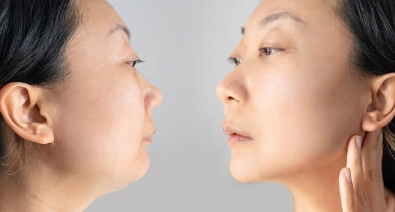 woman results chin liposuction before and after
