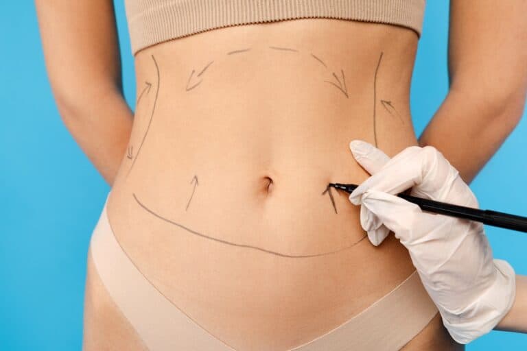 doctor marking female patient for lipo surgery