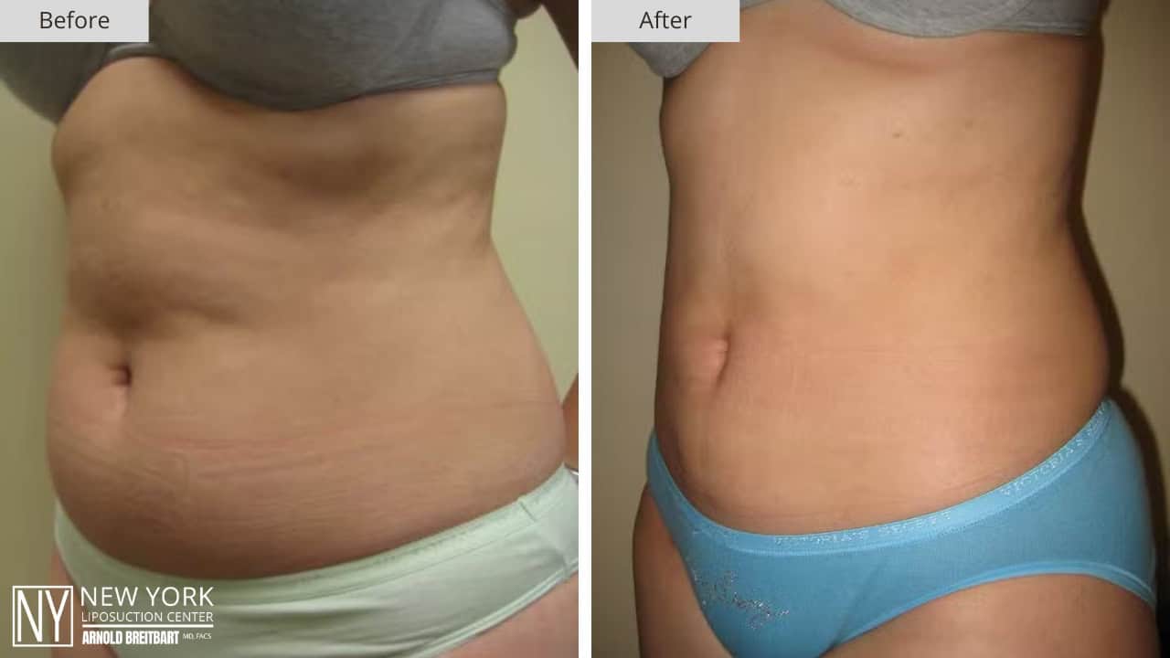 New York Liposuction Before and After Abdomen 2a
