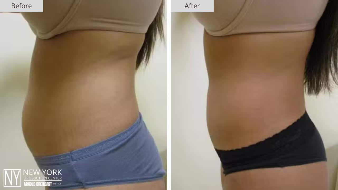 New York Liposuction Before and After Abdomen 4a