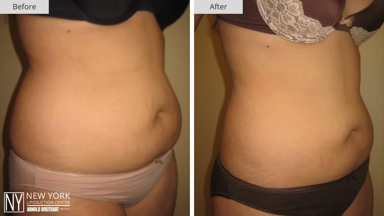 New York Liposuction Before and After Abdomen 5a