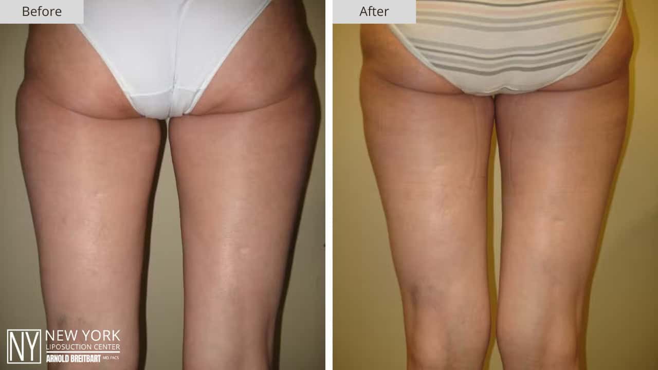 New York Liposuction Before and After Abdomen 6a