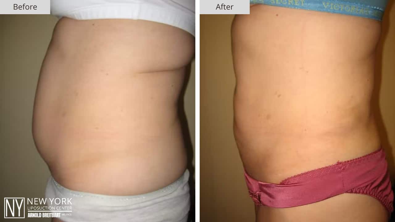 New York Liposuction Before and After Abdomen 7a