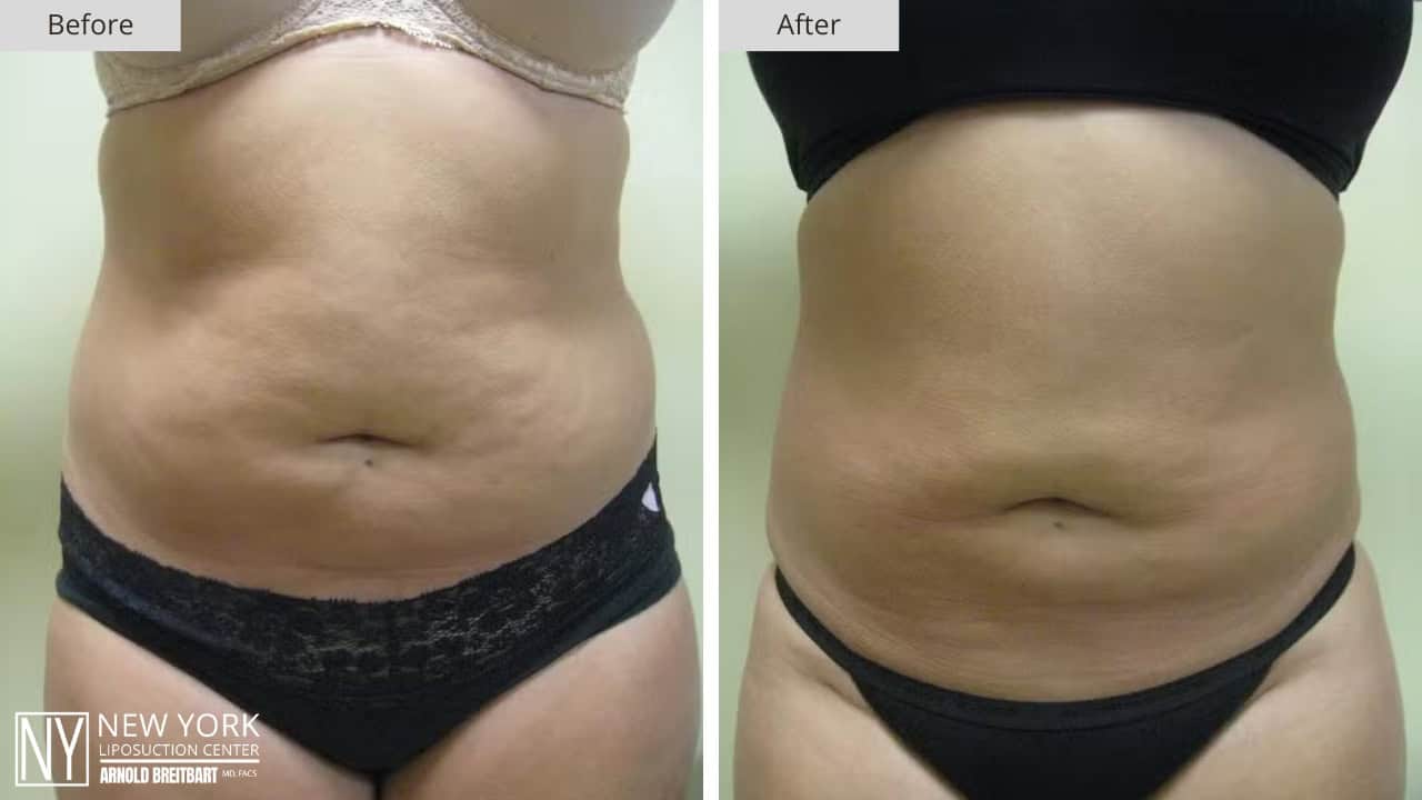 New York Liposuction Before and After Abdomen 8a