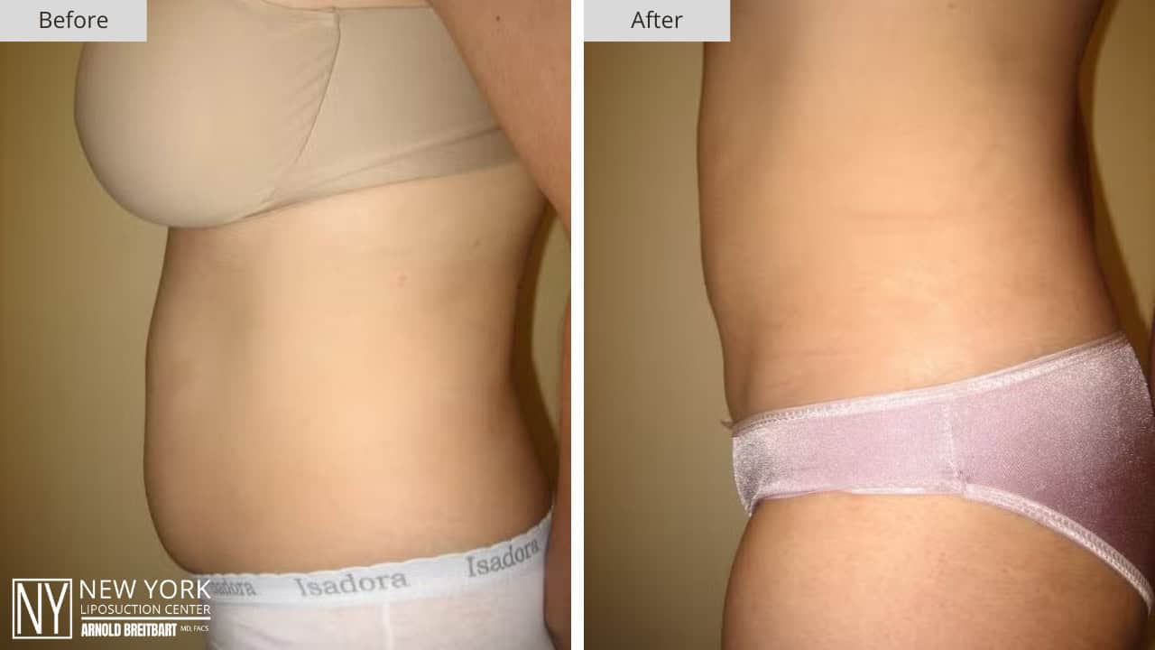 New York Liposuction Before and After Abdomen 9a