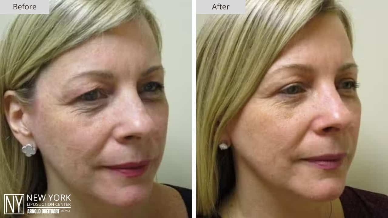 New York Liposuction Before and After Chin 2a