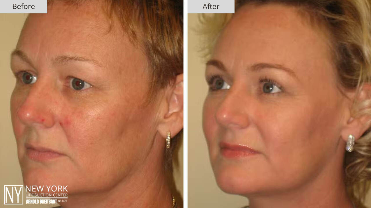 New York Liposuction Before and After Chin 3a