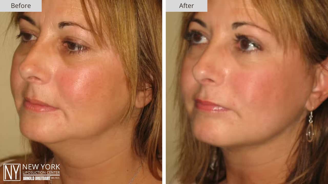 New York Liposuction Before and After Chin 4a