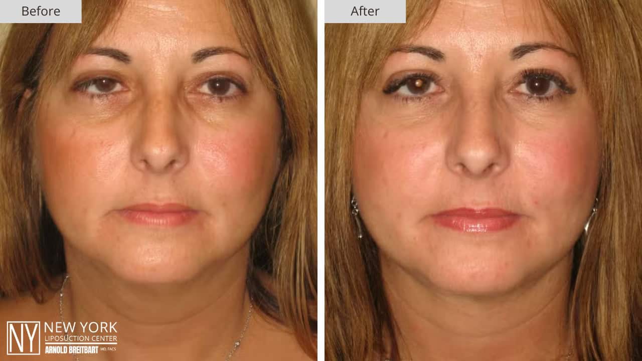New York Liposuction Before and After Chin 4b