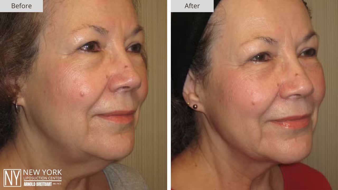 New York Liposuction Before and After Chin 6a