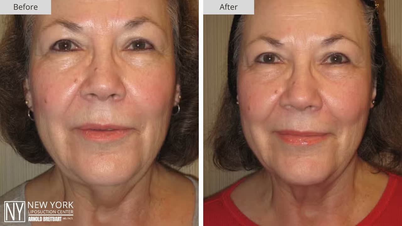 New York Liposuction Before and After Chin 6b