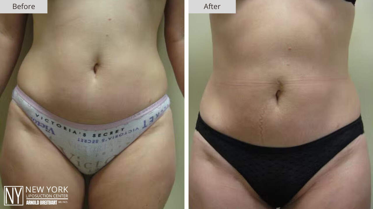 New York Liposuction Before and After Hip 2a