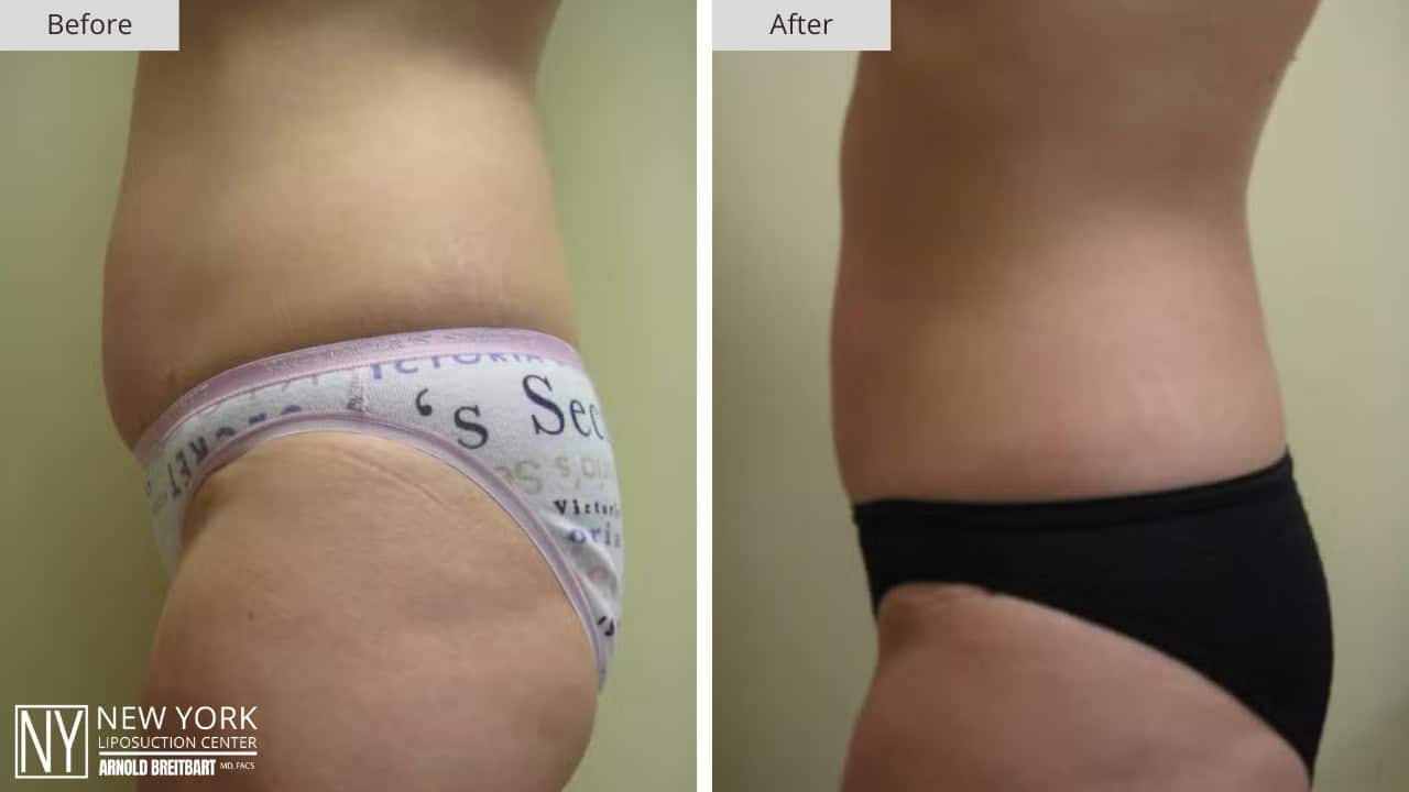 New York Liposuction Before and After Hip 2b