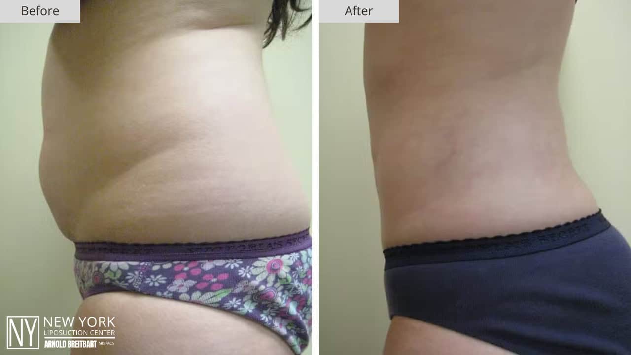New York Liposuction Before and After Love Handles 2a