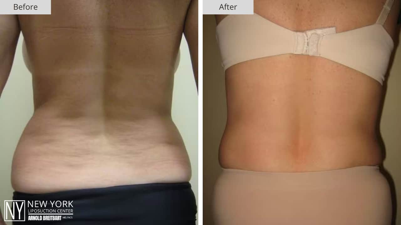 New York Liposuction Before and After Love Handles 3a