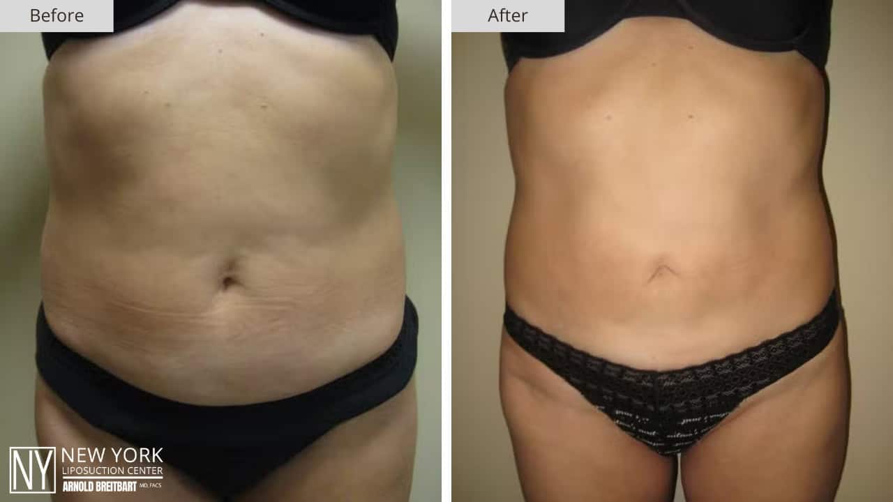 New York Liposuction Before and After Love Handles 4a