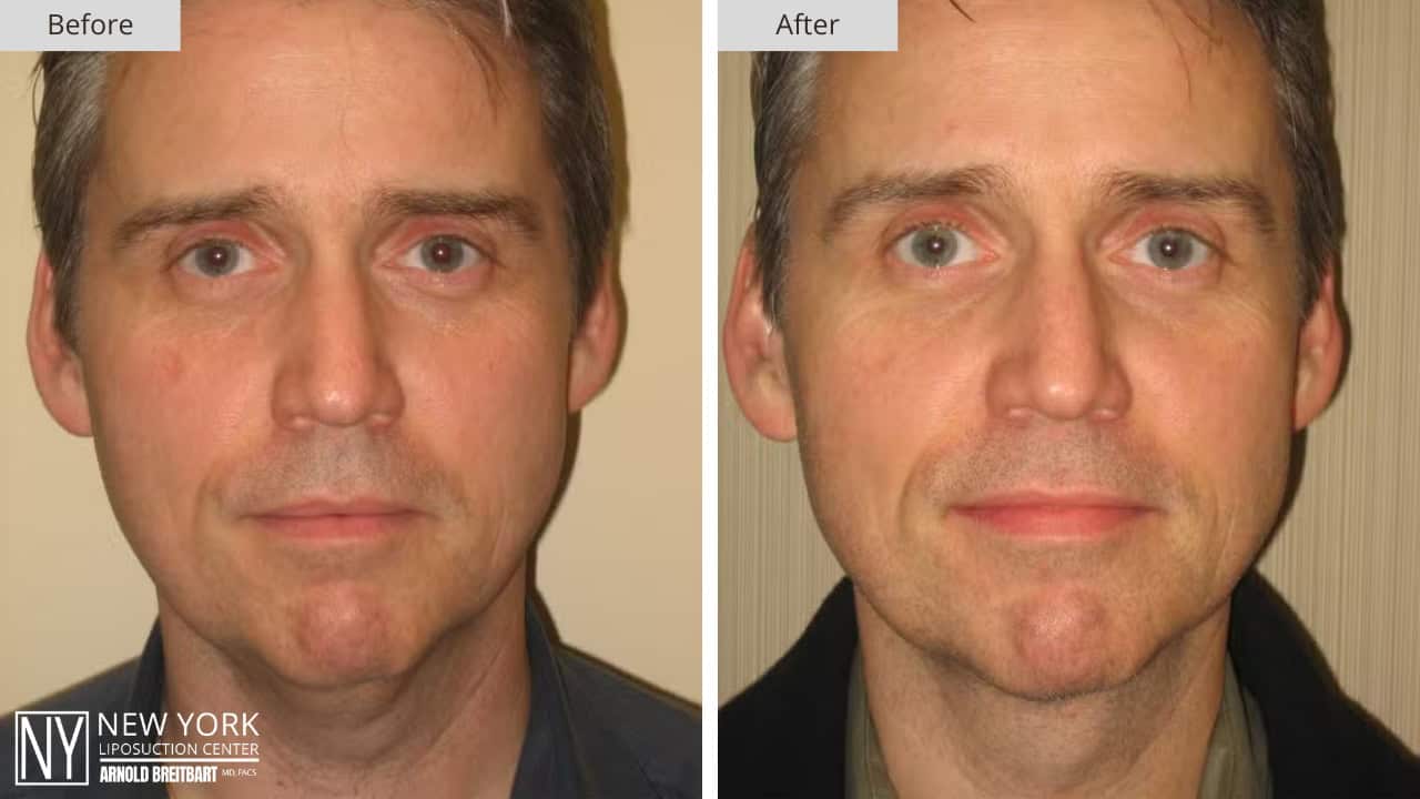 New York Liposuction Before and After Male Chin 9a