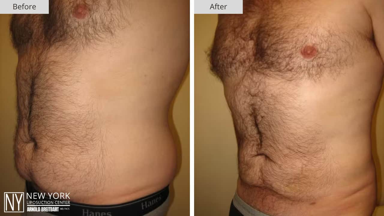 New York Liposuction Before and After Male Love Handle 3a