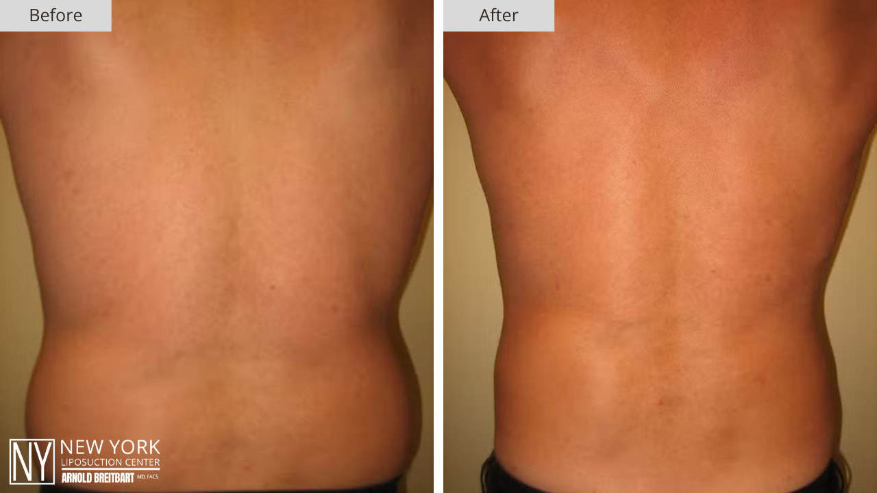 New York Liposuction Before and After Male Stomach 4a