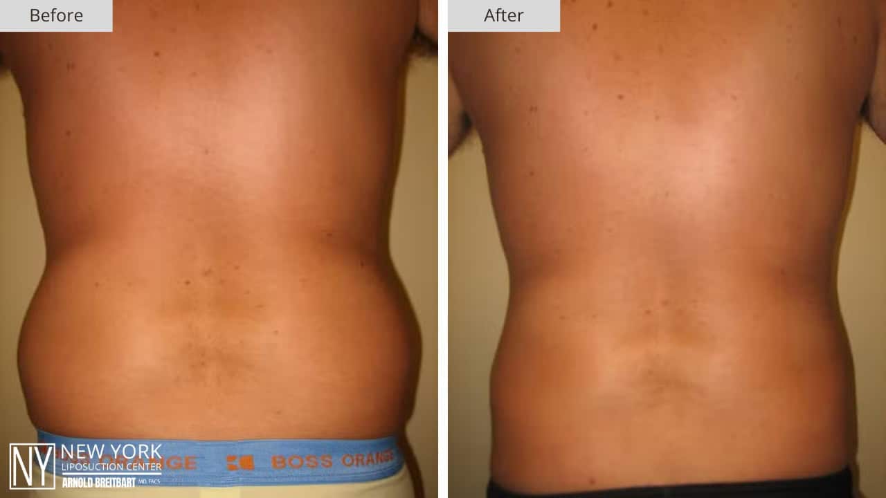 New York Liposuction Before and After Male Stomach 5a
