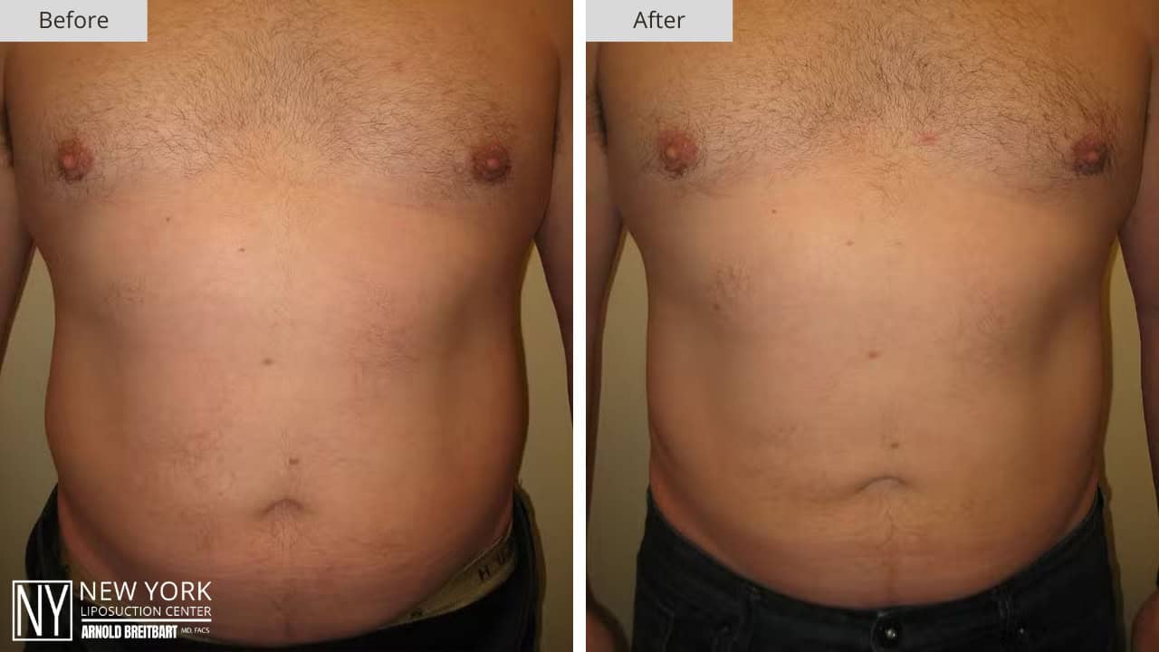 New York Liposuction Before and After Male Stomach 6a