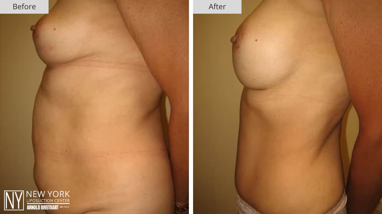 New York Liposuction Before and After Mommy Makeover 1b
