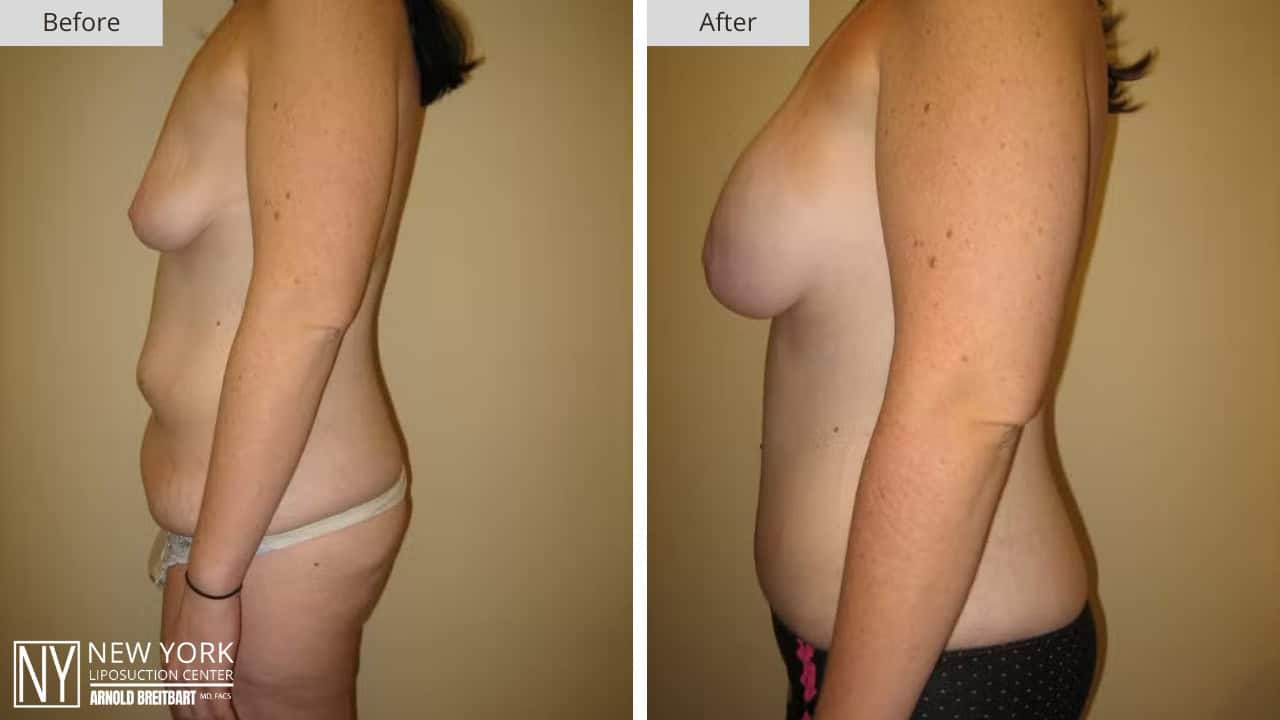 New York Liposuction Before and After Mommy Makeover 2a