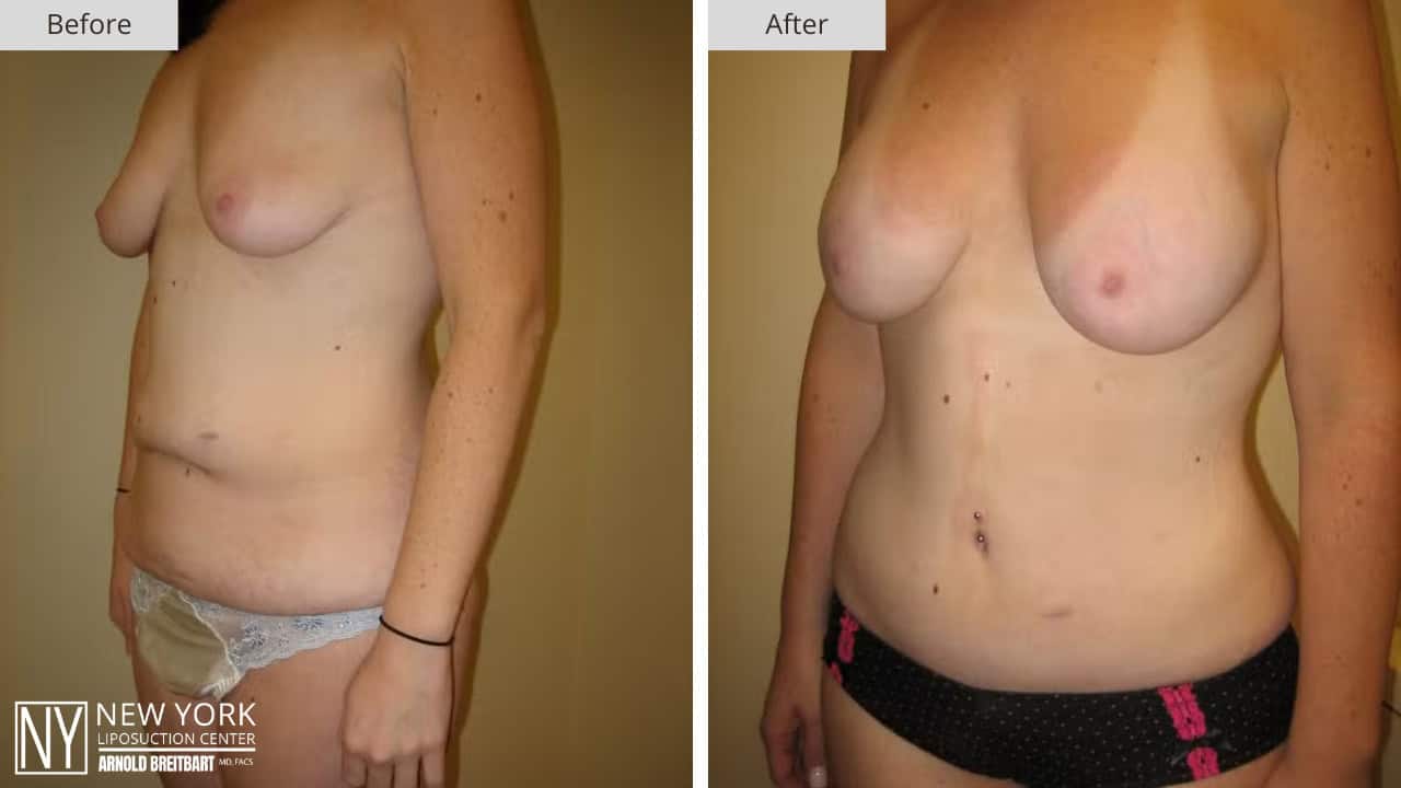 New York Liposuction Before and After Mommy Makeover 2b