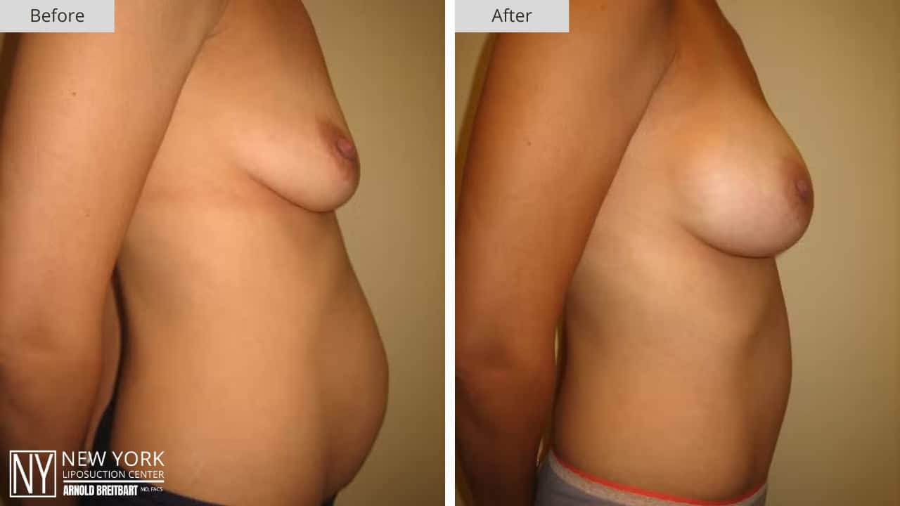 New York Liposuction Before and After Mommy Makeover 4a