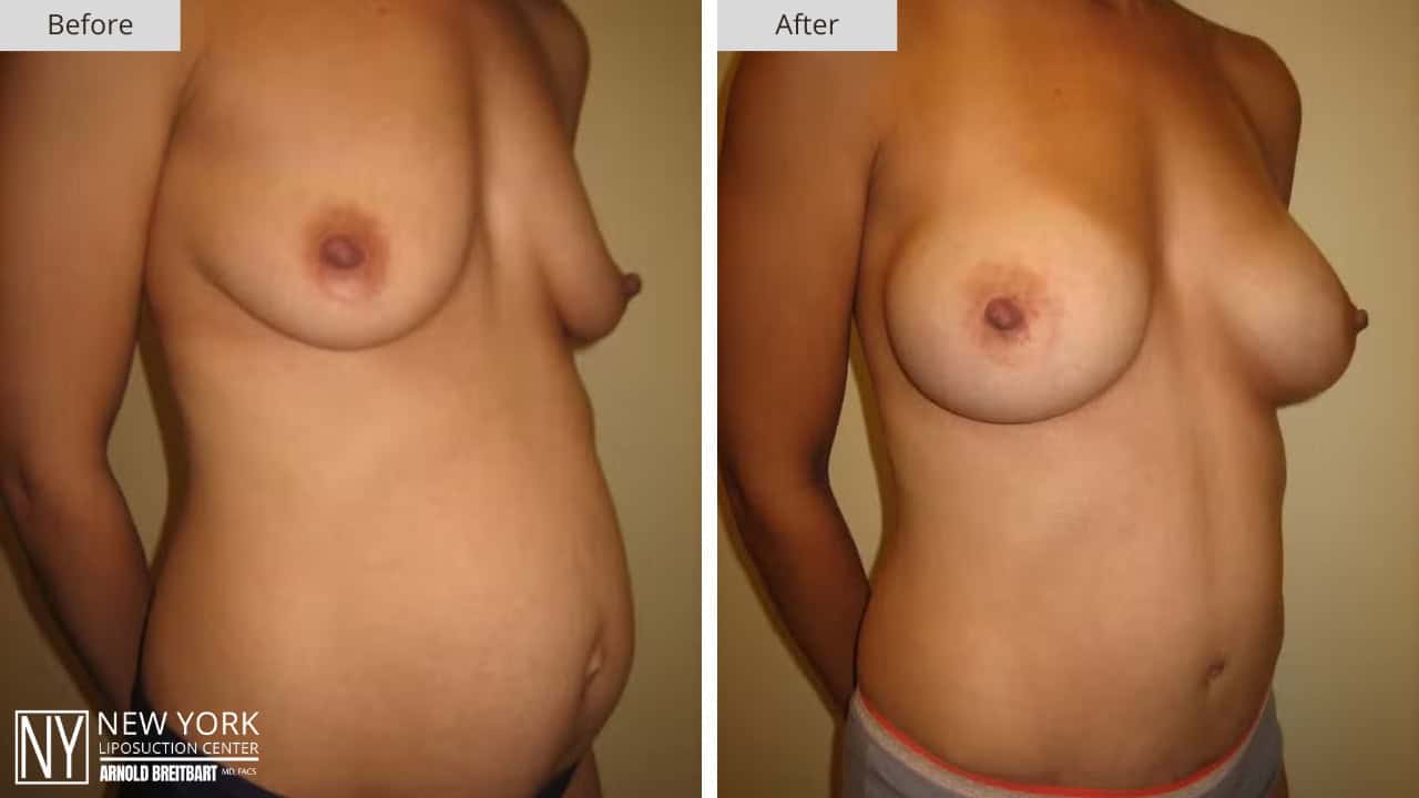 New York Liposuction Before and After Mommy Makeover 4b