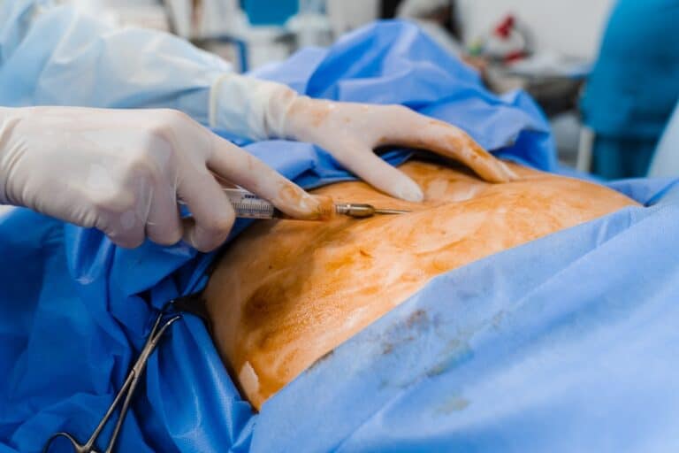 liposuction close up abdominoplasty