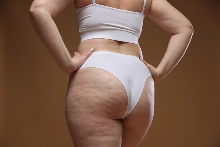 cellulite apperance on old female