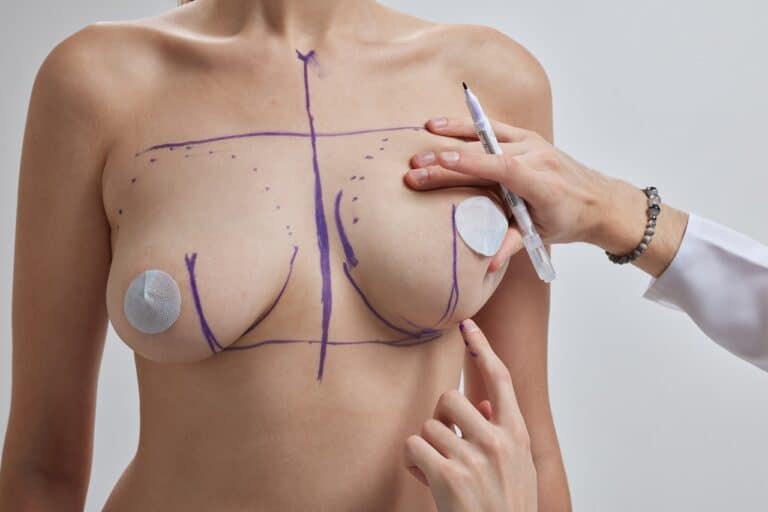 surgeon hands drawing marks on patient breasts