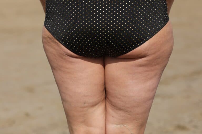 fat female cellulite