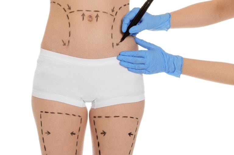surgeon drawing marks on patient